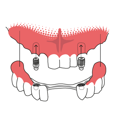 Druckknopfprothese auf Implantaten Veranschaulichung der Funktionsweise einer Druckknopfprothese, die auf Zahnimplantaten befestigt wird.
